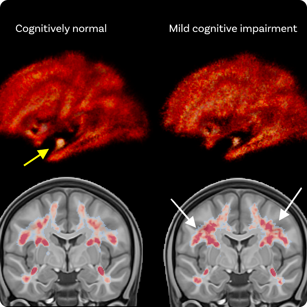 Mild Cognitive Impairment